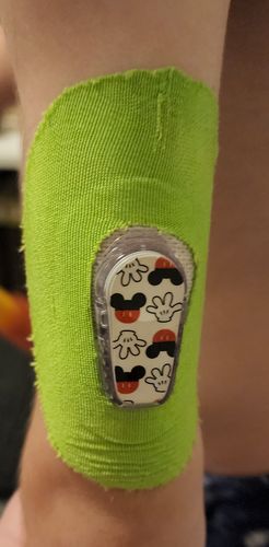 Customer photo review of Skin Grip Dexcom G6 Patches