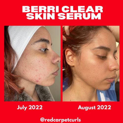 Customer photo review of BERRI-CLEAR+ 5 BERRY SUPERFRUIT SERUM