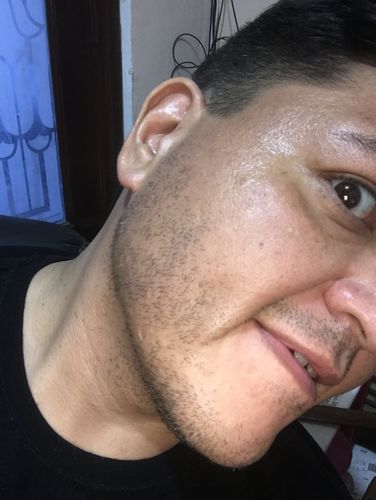 Customer photo review of Kit de Crecimiento de Barba y Bigote Bálsamo Minoxidil 15% + 1 Aceite Premium