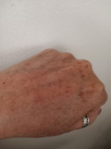 Customer photo review of Dermavel - Fibroblast Plasma Pen