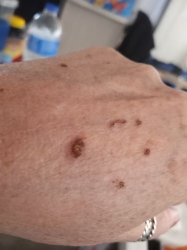 Customer photo review of Dermavel - Fibroblast Plasma Pen