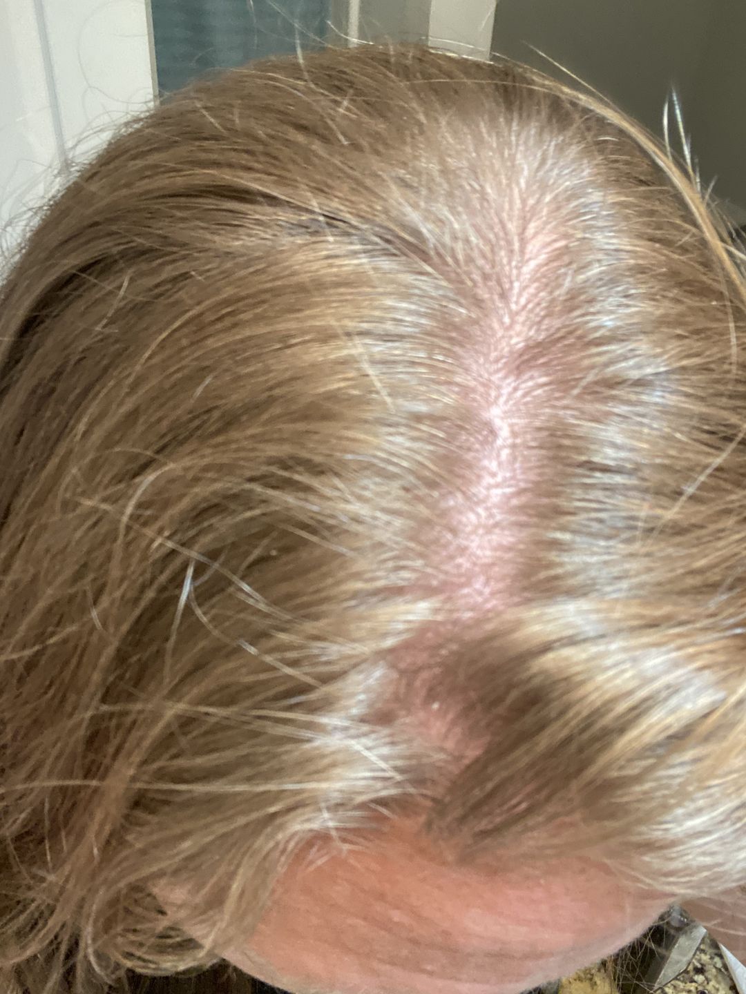 Customer photo review of Psoriasis Honey Renewing Shampoo