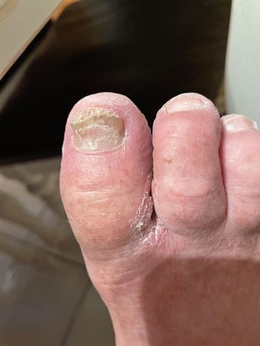 Customer photo review of Onychom - Antifungal Laser Device