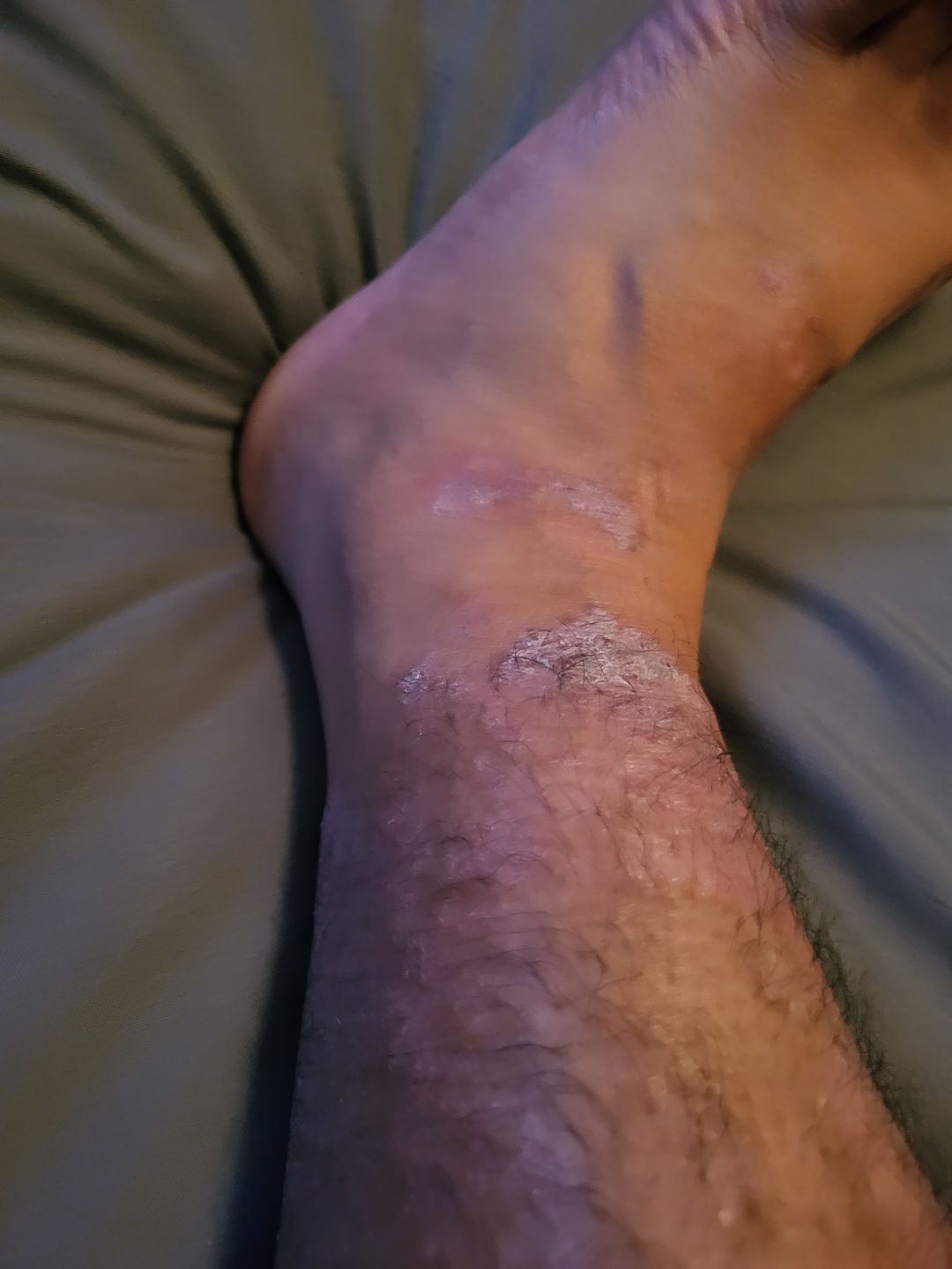 Customer photo review of Psoriasis Honey Gentle Cleansing Soap