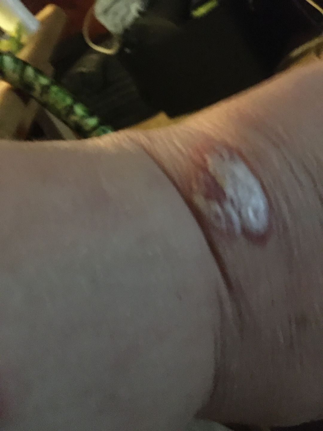 Customer photo review of Psoriasis Honey Ultimate Relief Kit