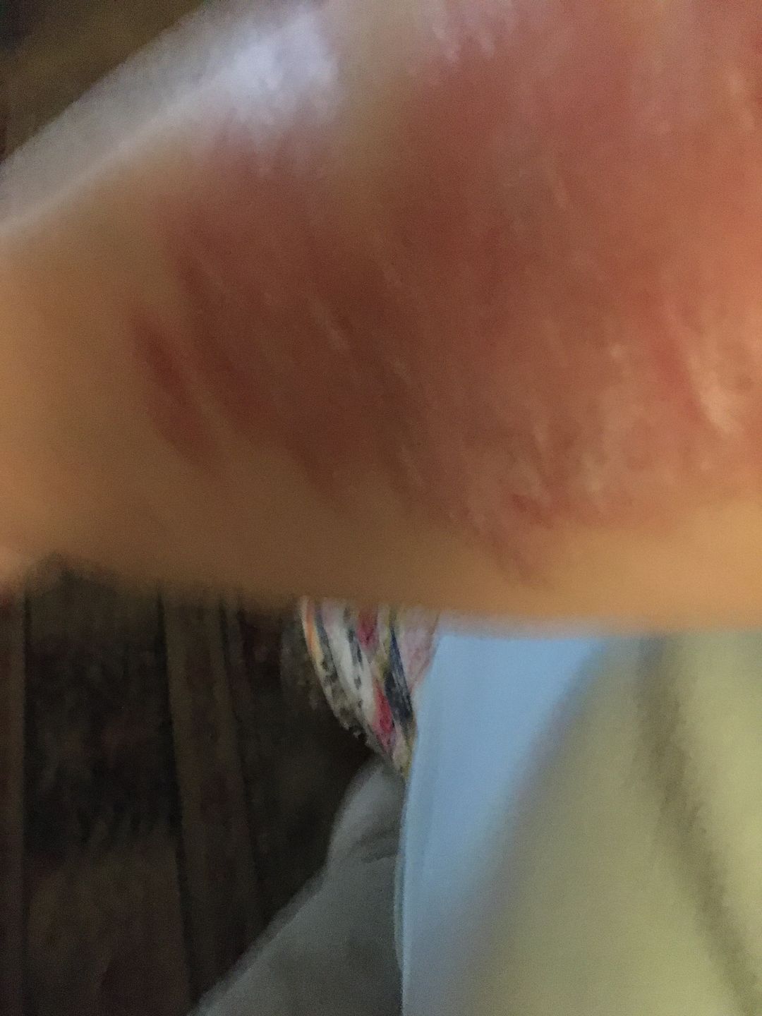 Customer photo review of Psoriasis Honey Gentle Cleansing Soap