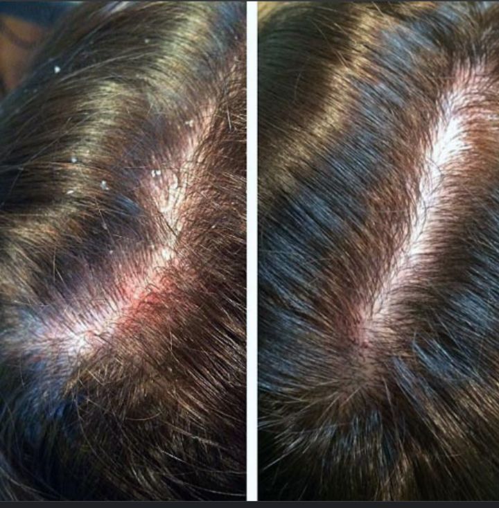 Customer photo review of SHAMPOO ANTICASPA GRASA FORMATO BARRA