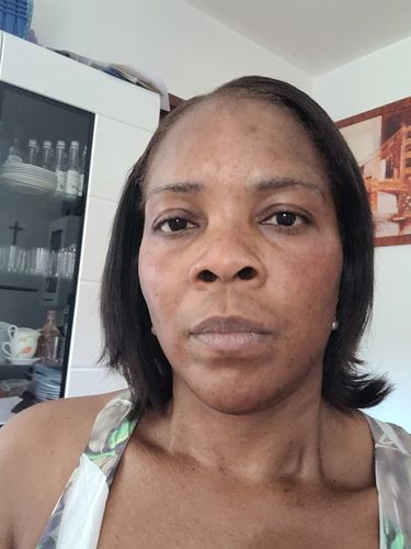 Customer photo review of 36 Hour Peeling Lotion 20ML