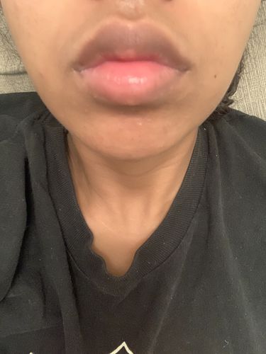 Customer photo review of LipFix: Filler