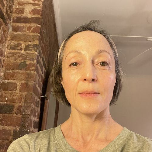 Customer photo review of EvenSkyn® Lumo: Premium Anti-Aging & Skin Tightening Handset