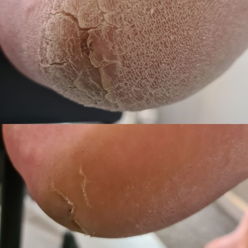 Customer photo review of LOVASKIN INSTANT FOOT PEEL Deluxe Kit BLACK EDITION - 25 Beauty foot treatments