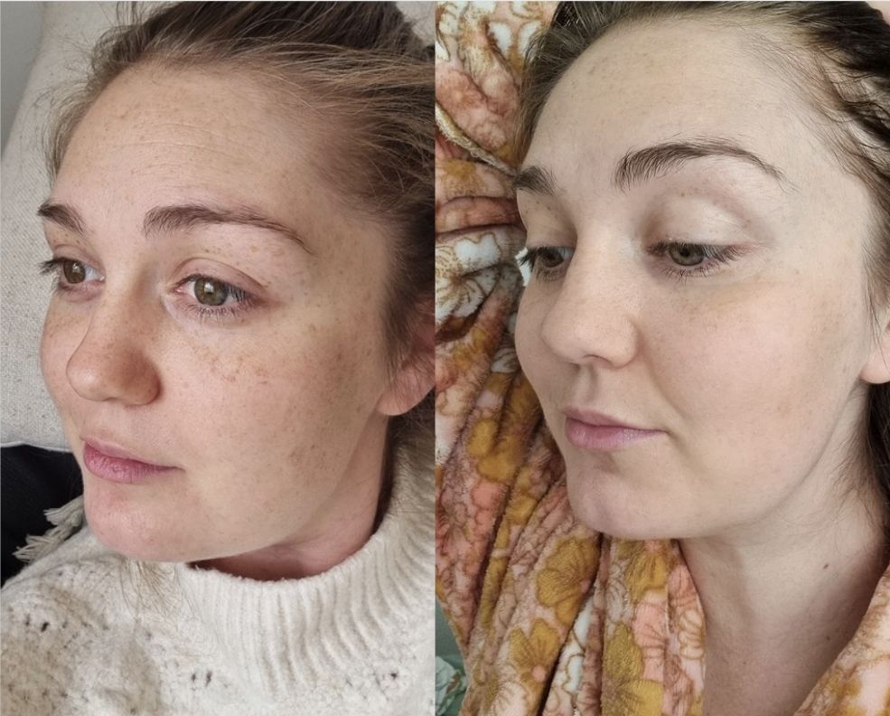 Customer photo review of Skin Restore Bundle | For Dry, redness, mature, sensitive skin