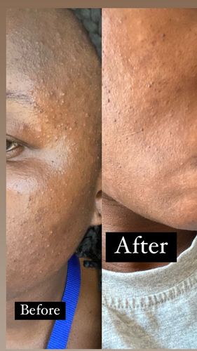 Customer photo review of Anti-Acne Serum