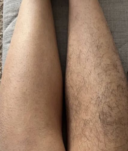 Customer photo review of Depilador Nuva Skin®