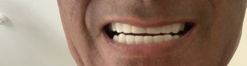 Customer photo review of Teeth-Veneer 2.0