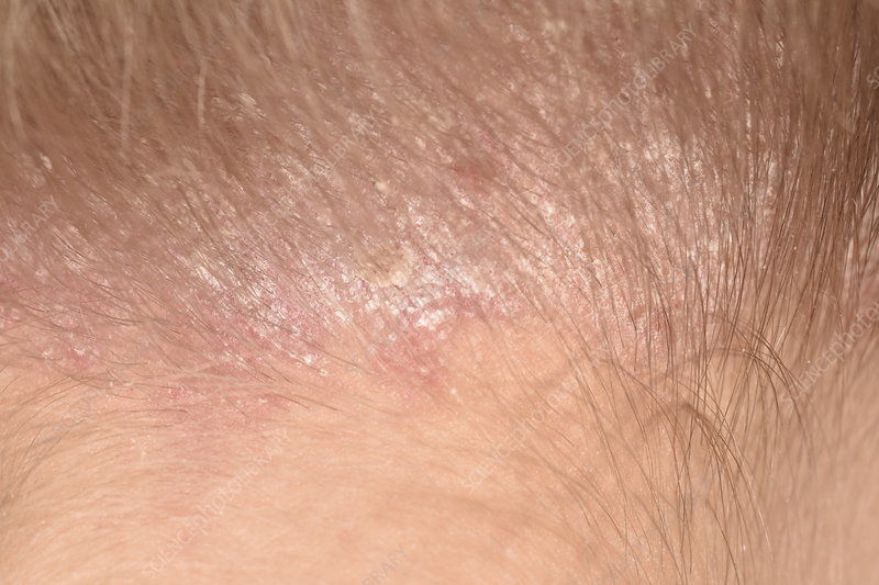 Customer photo review of Psoriasis Honey Nourishing Scalp and Skin Serum