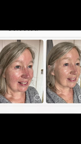 Customer photo review of Rosalique 3 in 1 Anti-Redness Miracle Formula SPF50