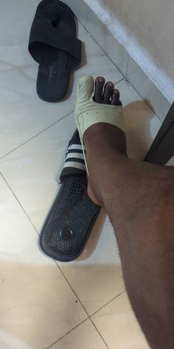 Customer photo review of BunionCare™ Elastic Bunion Corrector