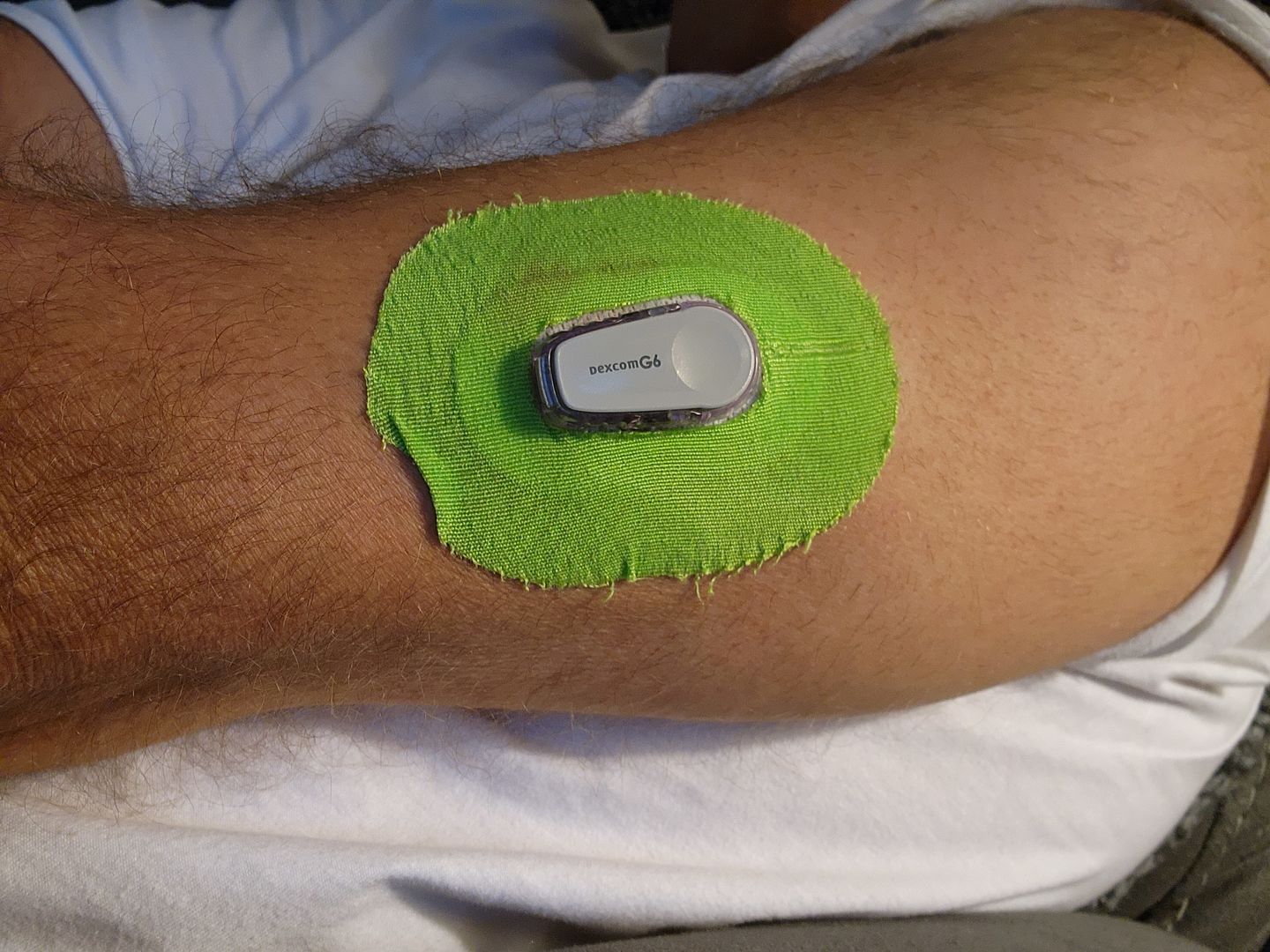 Customer photo review of Skin Grip MAX Dexcom G6 Patches
