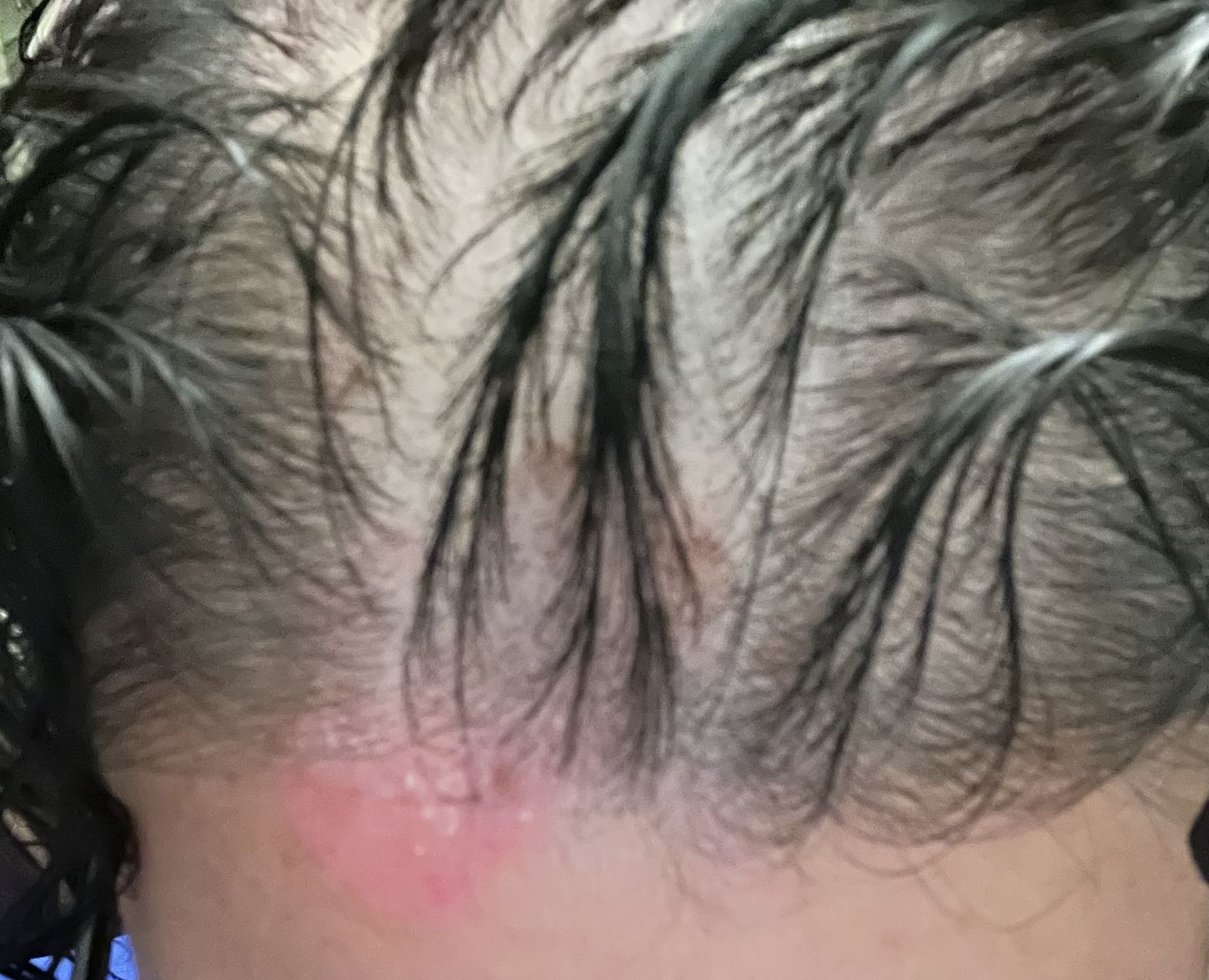 Customer photo review of Psoriasis Honey Scalp Nourishing Kit