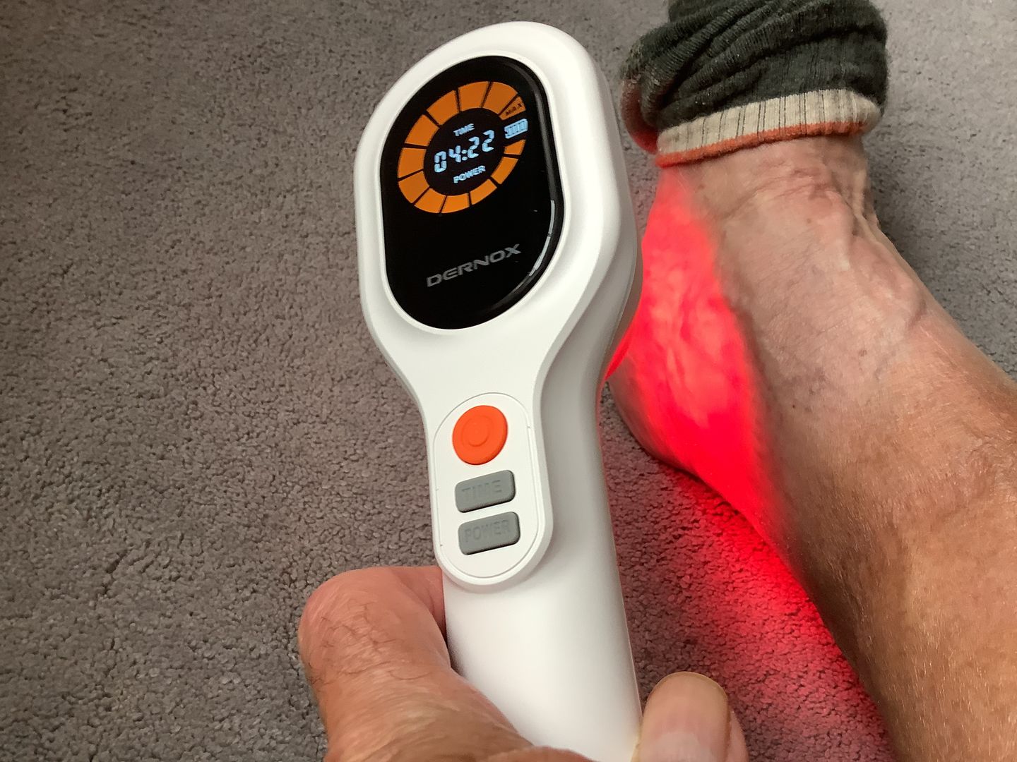 Customer photo review of DERNOX™ Handheld Pain Relief Cold Laser Device