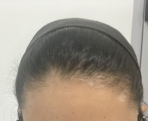 Customer photo review of קרם טיפולי לקרקפת | SEBO & PSO SCALP LOTION