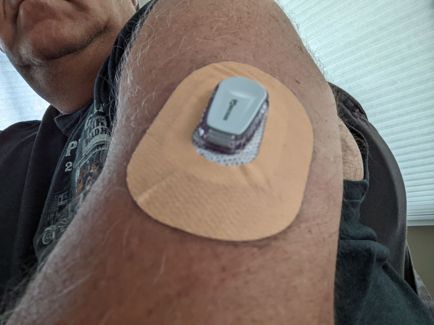 Customer photo review of Skin Grip MAX Dexcom G6 Patches