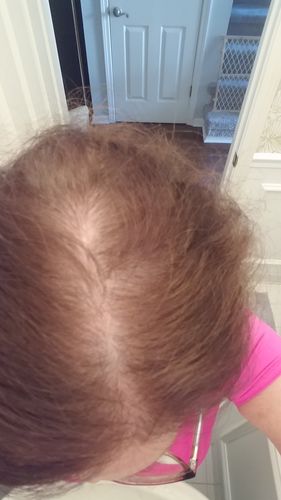 Customer photo review of NutraM Topical Melatonin Hair Growth Serum for Thinning Hair - Clinically Researched - 2oz