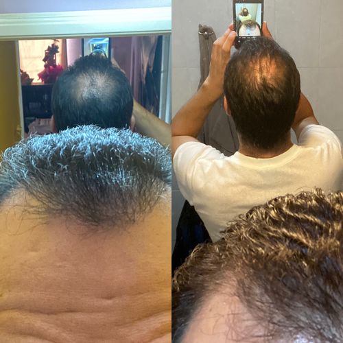 Customer photo review of HAIRtamin Fórmula Avanzada