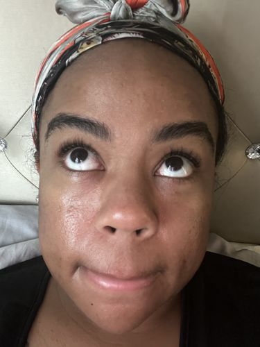 Customer photo review of FRESH FACE PACKAGE (Cleanser x Toner x Serum)