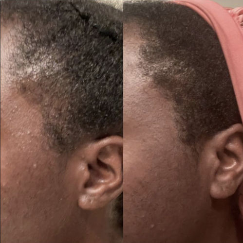 Customer photo review of India’s Secret Ancient Ayurvedic Hair Follicle Elixir (4 sizes)