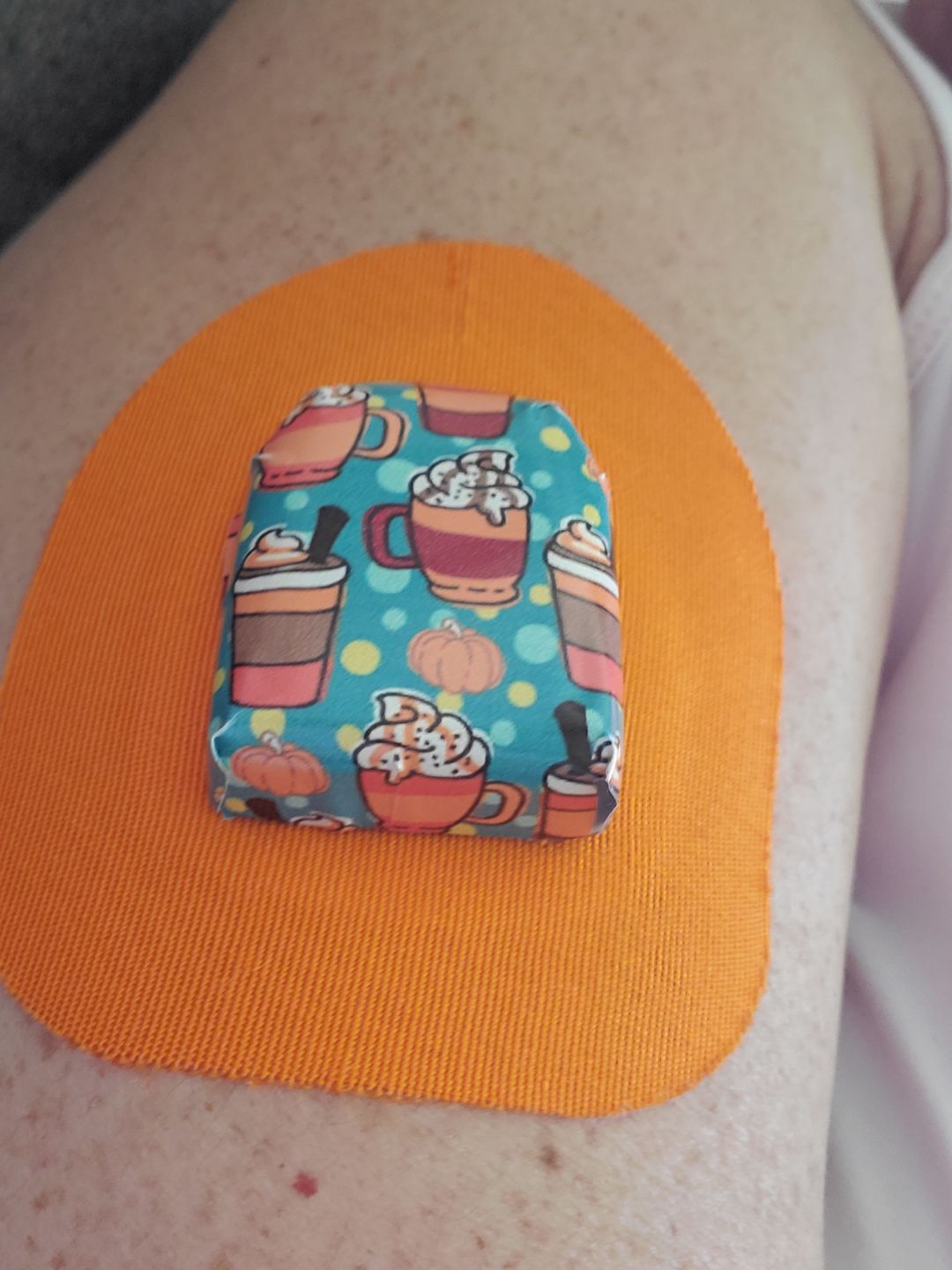 Customer photo review of Skin Grip Original - Omnipod Adhesive Patches