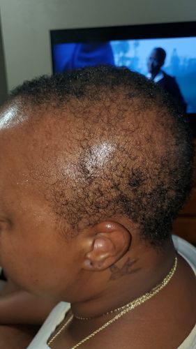 Customer photo review of Grow Pro: Derma Roller for Hair & Beard