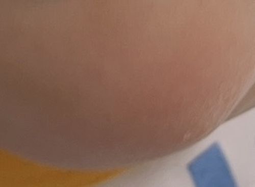 Customer photo review of 口水疹護理套裝 (濕疹修護霜  + 深層潔膚水)