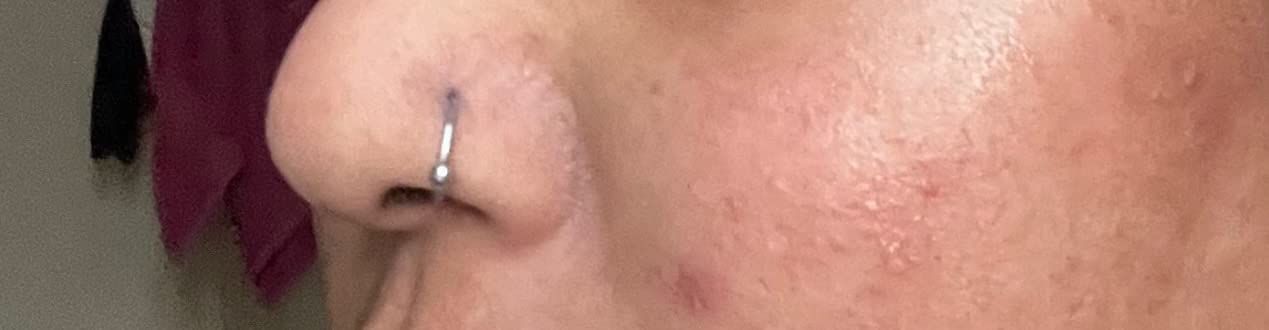 Customer photo review of Base Labs Piercing Bump Treatment & Keloid Bump Removal Drops 15ml