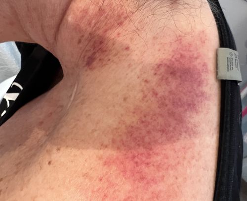 Customer photo review of Achedaway Scraper - The World’s First Heated Muscle Scraper