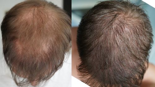 Customer photo review of Ultimate Hair Accelerator Bundle