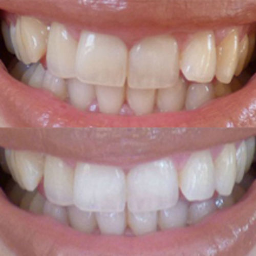 Customer photo review of Teeth Whitening Kit