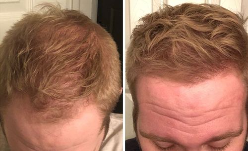 Customer photo review of Complete Hair Growth System