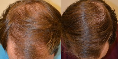 Customer photo review of Ultimate Hair Accelerator Bundle