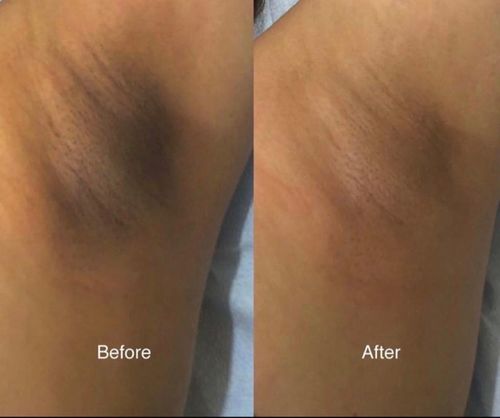 Customer photo review of Intimate Lightening Cream