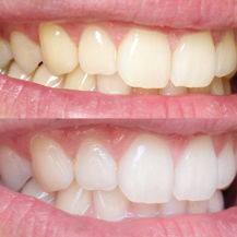 Customer photo review of Teeth Whitening Strips