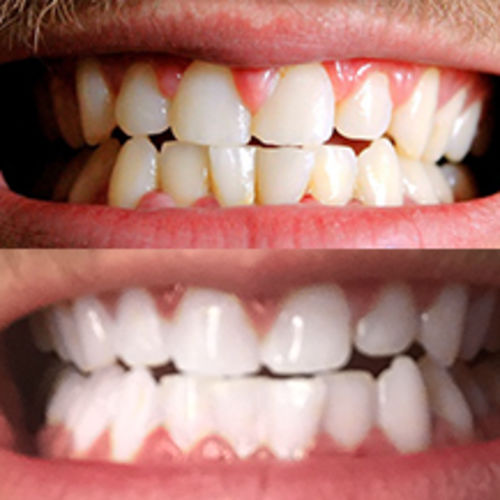 Customer photo review of Teeth Whitening Kit