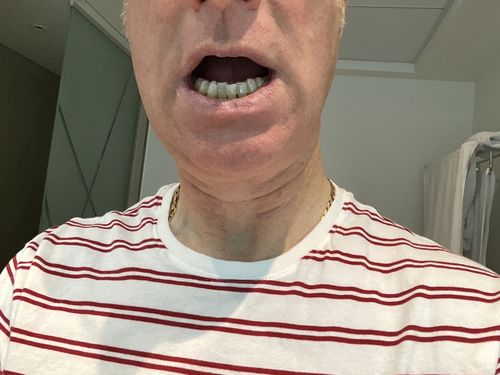Customer photo review of SleepPro Retainers