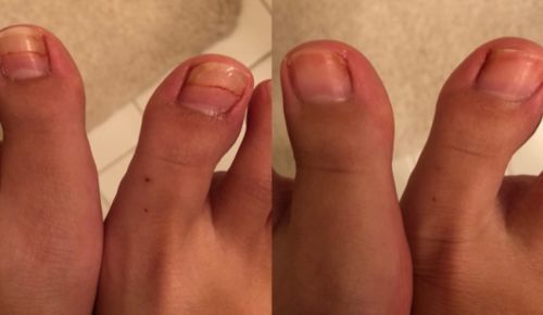 Customer photo review of German ToenailPlus™ Anti Paronychia Relief Oil