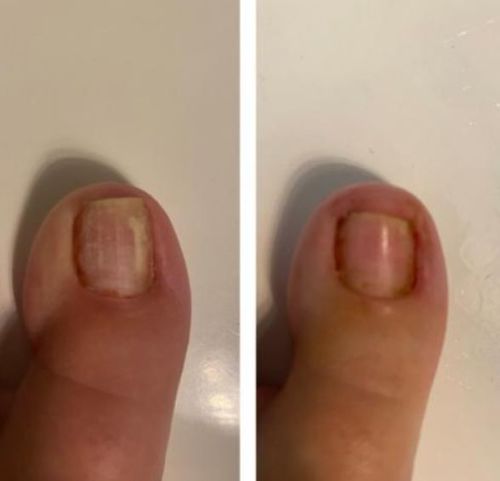 Customer photo review of German ToenailPlus™ Anti Paronychia Relief Oil
