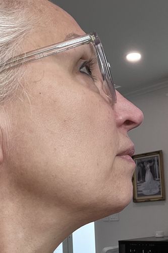 Customer photo review of EvenSkyn® Lumo: Premium Anti-Aging & Skin Tightening Handset