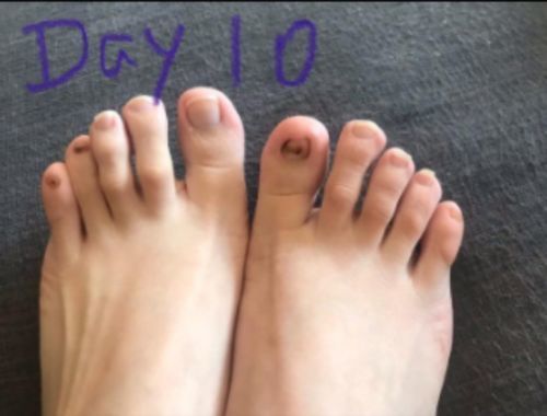 Customer photo review of German ToenailPlus™ Anti Paronychia Relief Oil