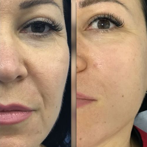 Customer photo review of EvenSkyn® Lumo: Premium Anti-Aging & Skin Tightening Handset