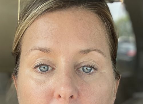 Customer photo review of EvenSkyn® Lumo: Premium Anti-Aging & Skin Tightening Handset